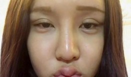 整容失败脸很鼓的网红吃瓜,美丽代价太大！